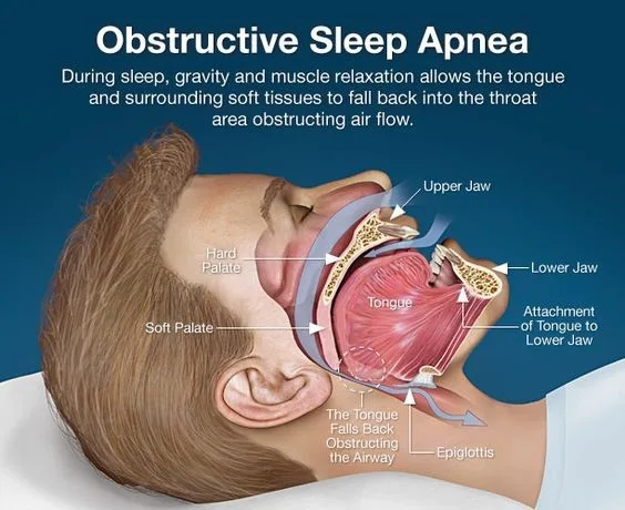 f0aabaa79c30406063f1ed3b46c53c51-jpg Complete Guide to Understanding Sleep Apnea: Symptoms, Causes, and Treatments in 2024